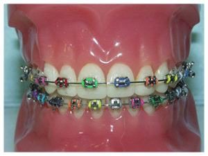 metal braces