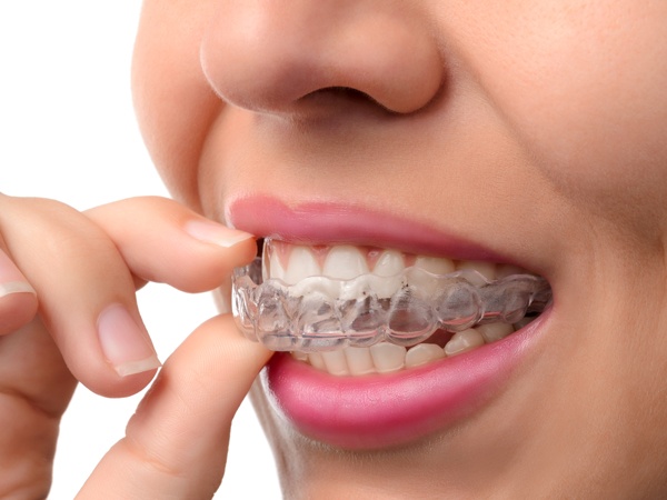 Invisalign